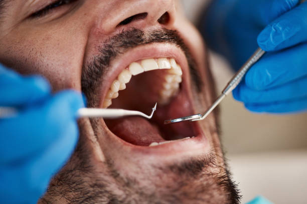Best Emergency Dentist for Lost Fillings or Crowns in Ocklawaha, FL